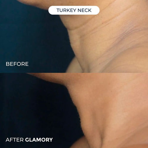 Erae Age-Reverse™ Bio-Infusion